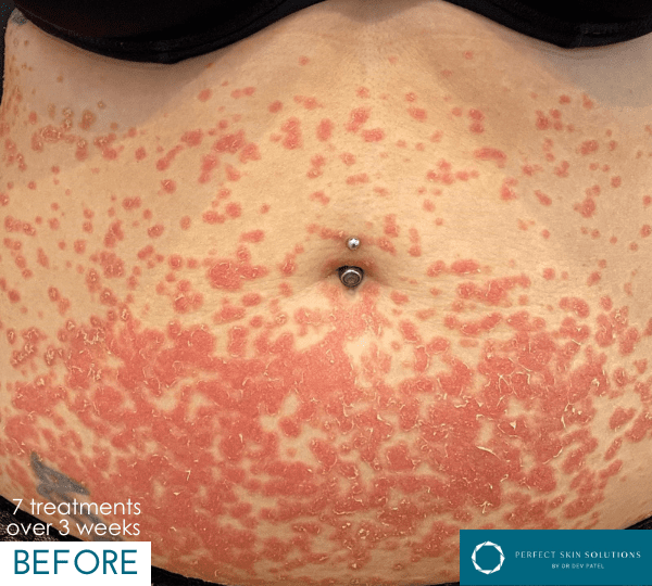 phototherapy treatment before