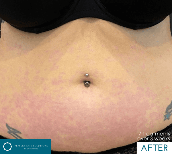 phototherapy treatment after