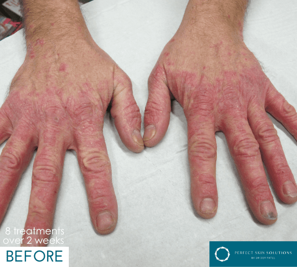 dermalux treatment before