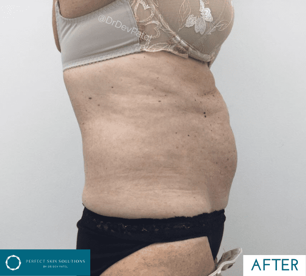fat loss treatment after