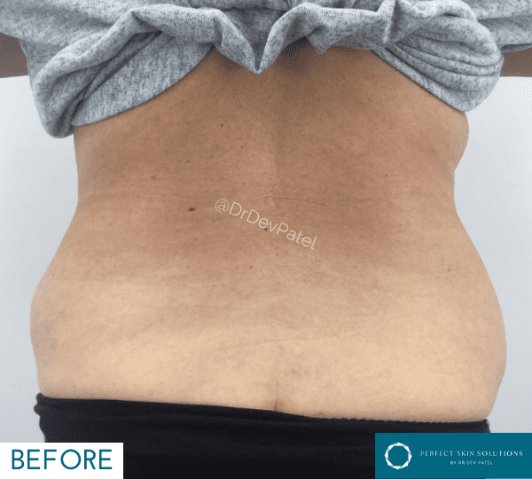 emerald laser before