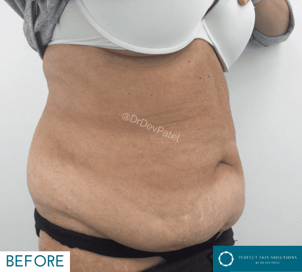 fat loss treatment before