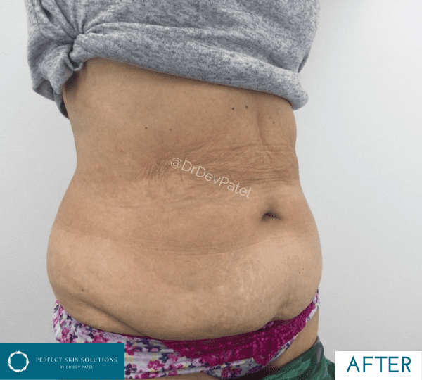 fat loss treatment after