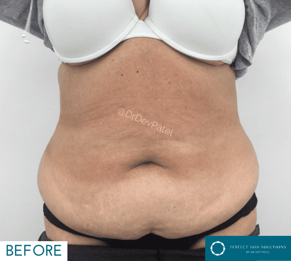 weight loss treatment before