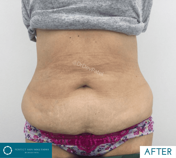 weight loss treatment after