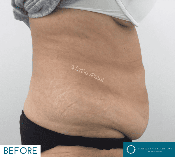 fat loss treatment before