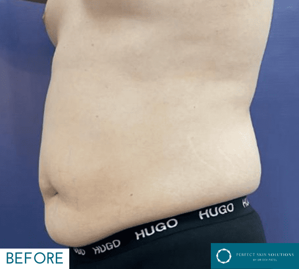 emerald laser before