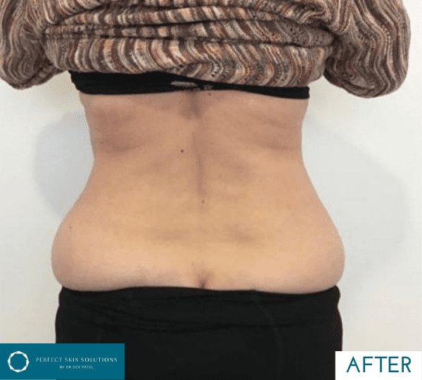 emerald laser treatment after