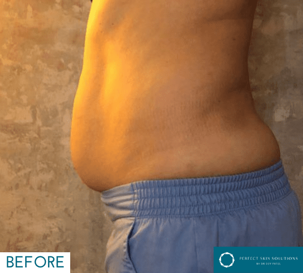 fat loss treatment before