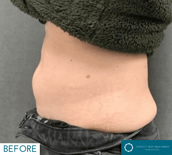 emerald laser before