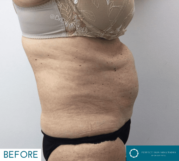 Fat loss treatment before