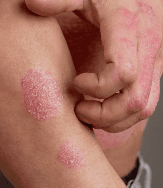 Understanding Psoriasis: Causes, Symptoms & Modern Treatment Options
