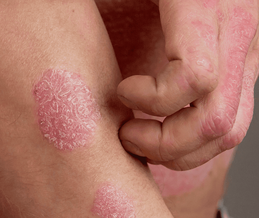 psoriasis