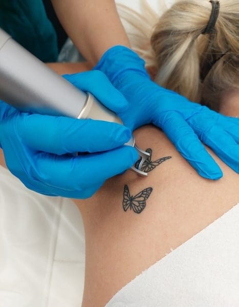 Does Tattoo Removal Work?