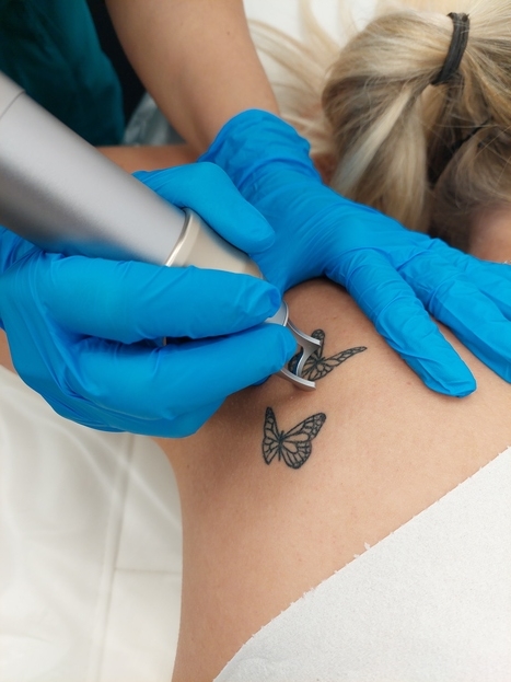 Laser Tattoo Removal | Tattoo Removal at Perfect Skin Solution - Portsmouth
