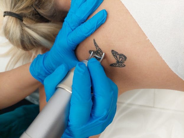 Patch test for laser tattoo removal already showing great results! Book  your free consultation at the following link: https://bit.ly/3fADon4  #swansea... | By 1192 Laser And Beauty ClinicFacebook