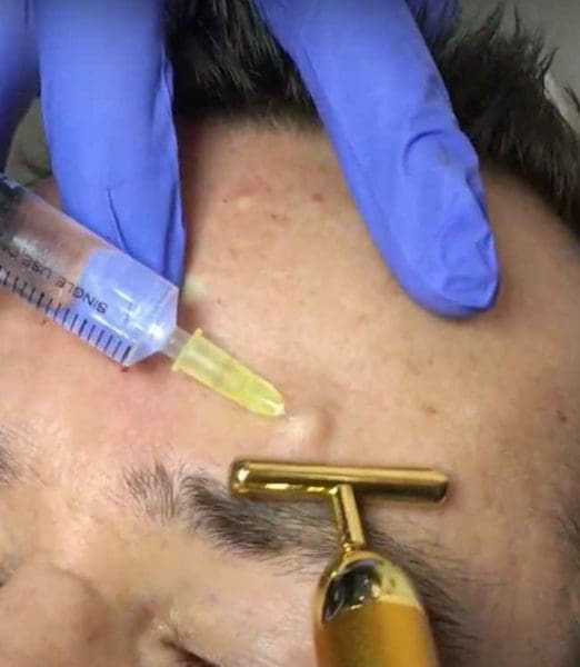 Anti-Wrinkle Injections Myths and Facts