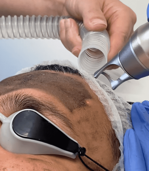 Carbon Laser Facial: The Ultimate Non-Invasive Skincare Treatment at Perfect Skin Solutions