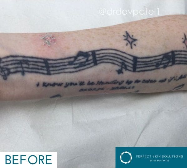 How Picomax Laser Removes Unwanted Tattoos Fast