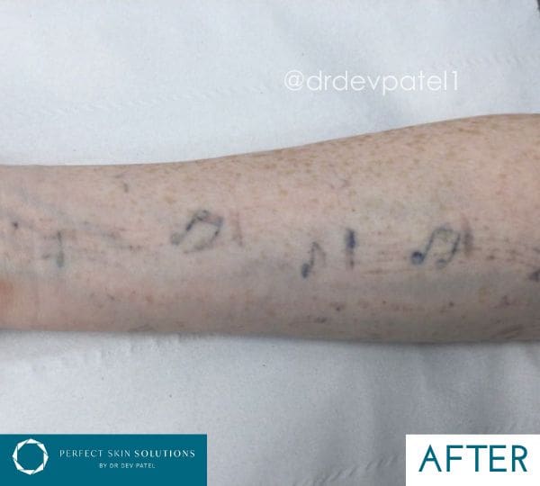 Minimal Downtime Tattoo Removal Using Picomax Laser
