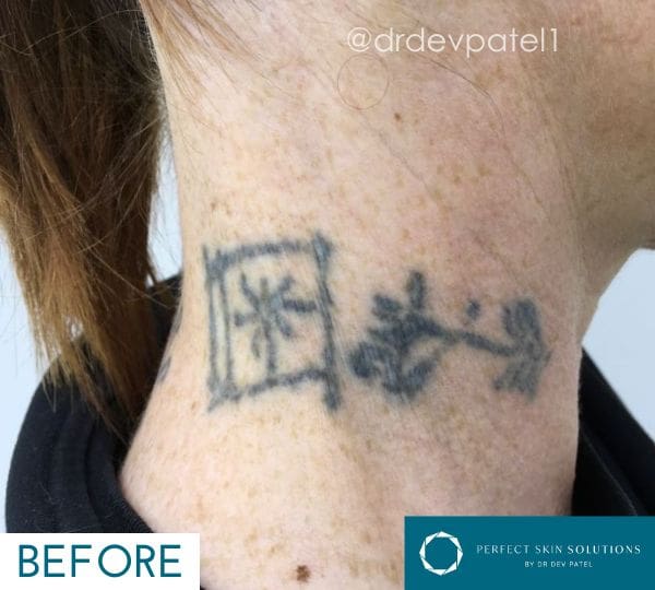 Picomax Laser in Action Tattoo Removal Procedure