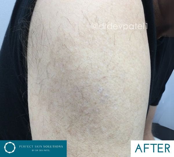 Picomax Laser Tattoo Removal Before and After Results