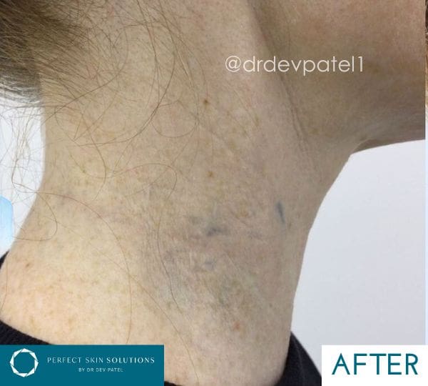 Safe Effective Tattoo Removal with Picomax Laser