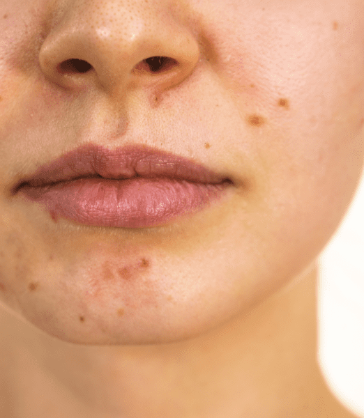 Private Skin Tag Removal