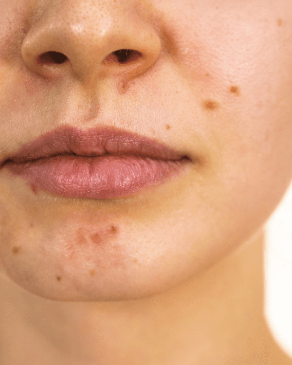 Private Skin Tag Removal