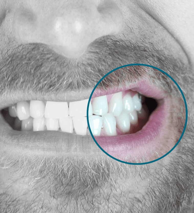 Teeth Grinding (Bruxism) Perfect Skin Solutions
