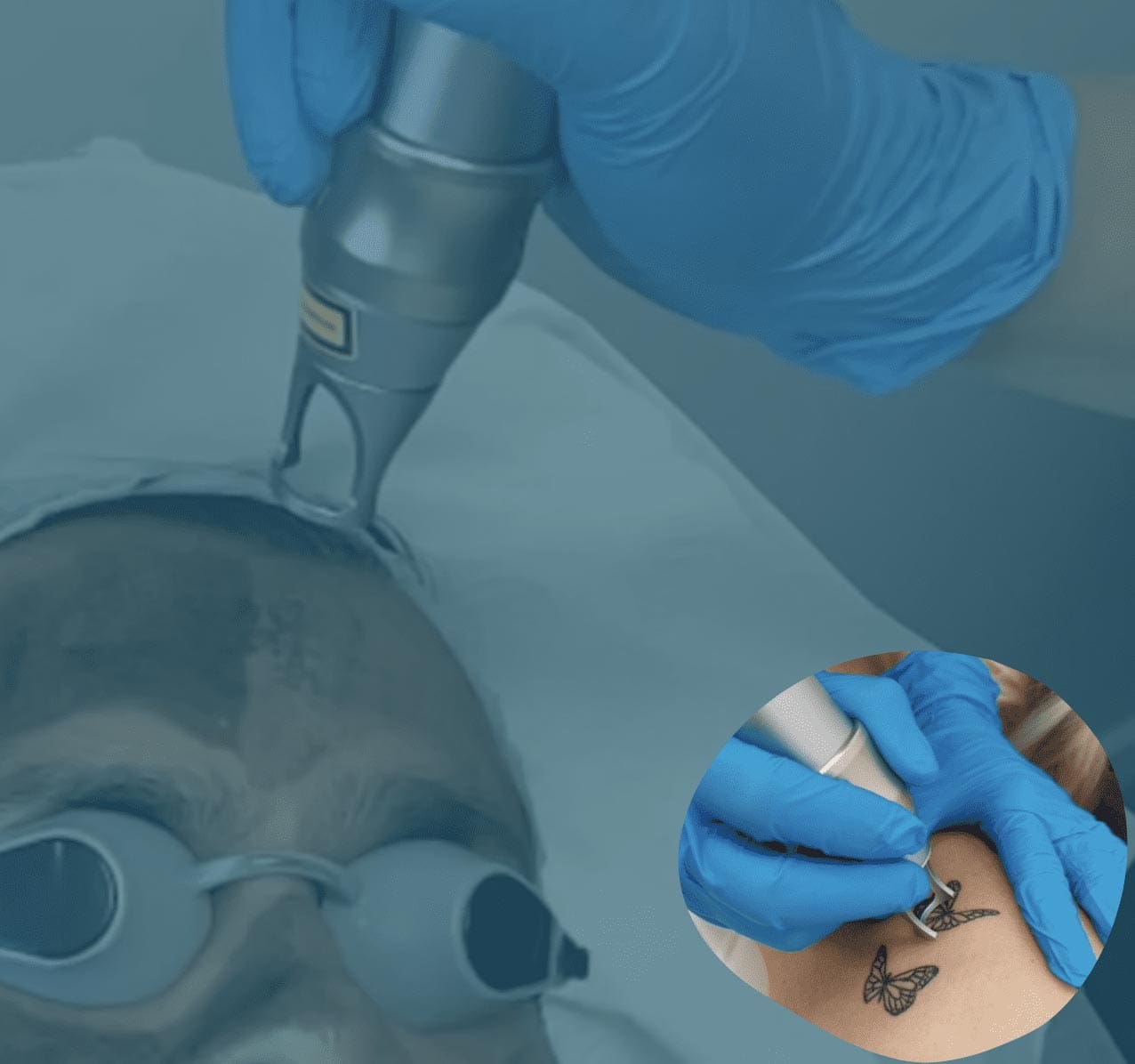 Perfect Skin Solutions - PicoMax Laser