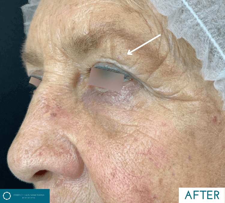 neogen psr treatment after