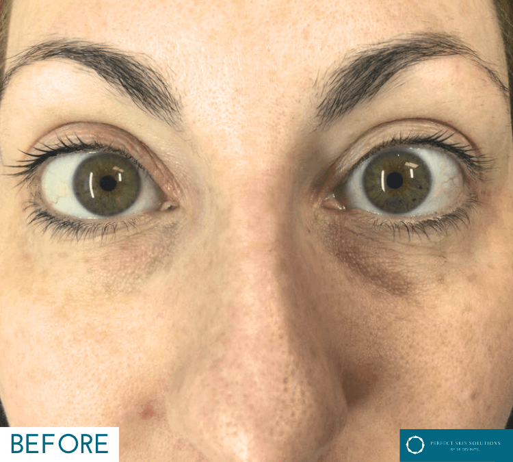 neogen per treatment before