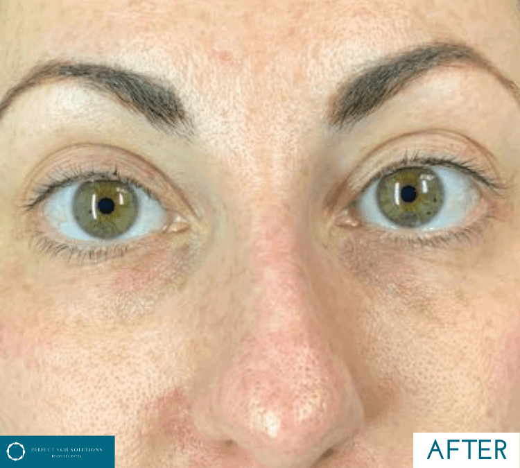 neogen pst treatment after