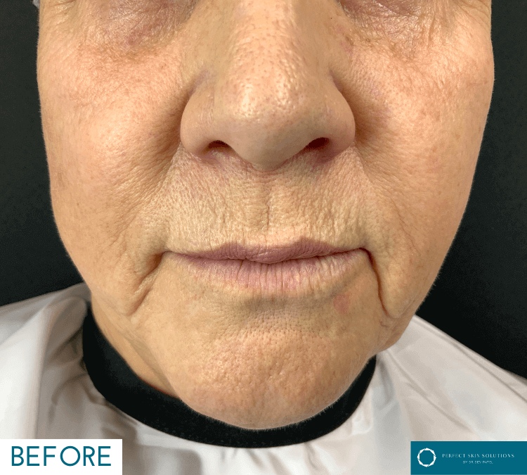 neogen pst treatment before