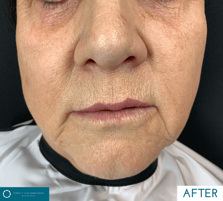 neogen pst treatment after