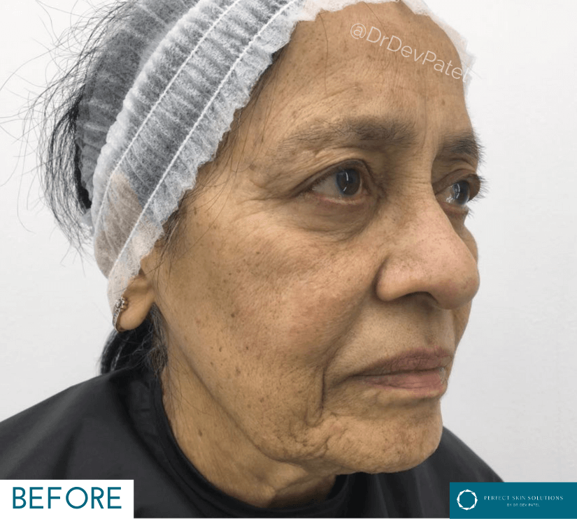 Sofwave treatment before