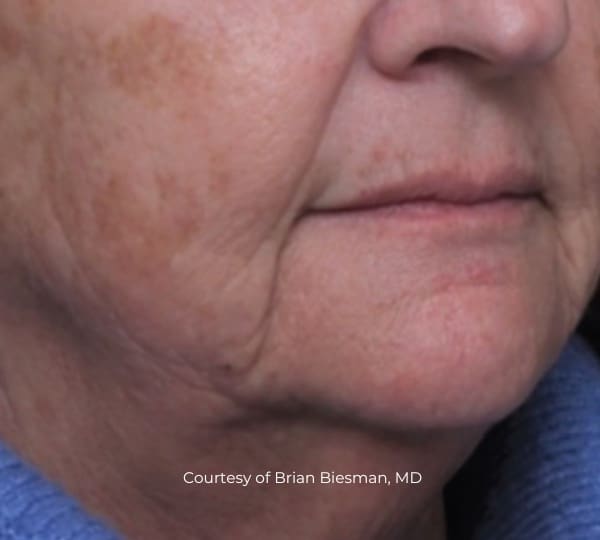 ultraclear patient before