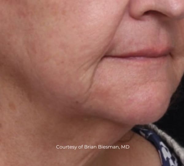 ultraclear patient after