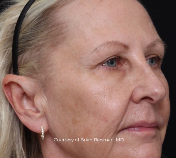 Ultraclear patient before treatment