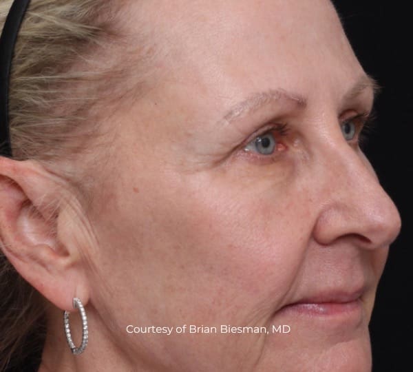 ultraclear patient after treatment