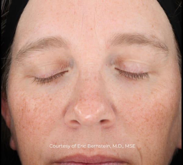 ultraclear patient before treatment