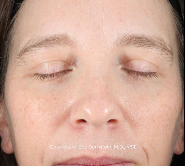 UltraClear Patient after treatment