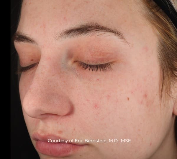 ultraclear patient before treatment