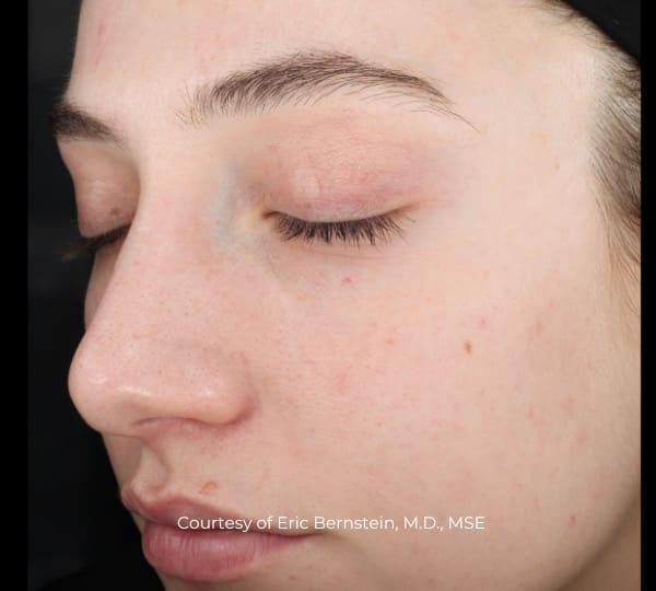 UltraClear Patient After Treatment