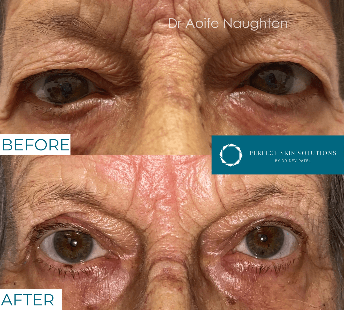 Before and after photo of eyes from blepharoplasty eyelid surgery man