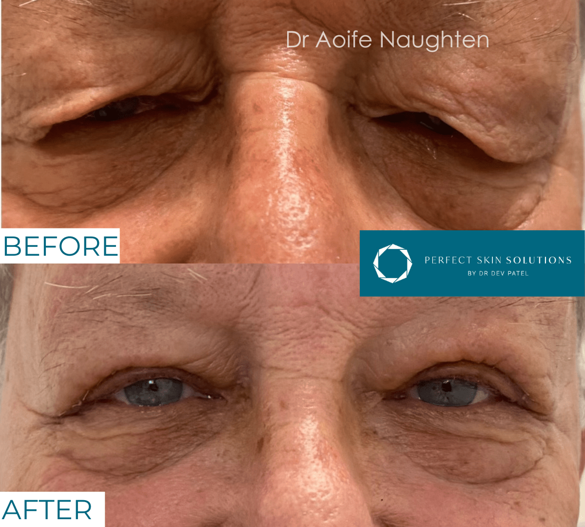 Before and after photo of eyes from blepharoplasty eyelid surgery man