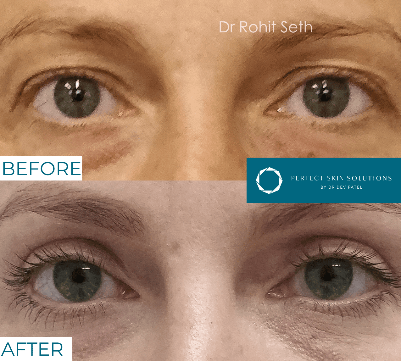 Before and after photo of eyes from blepharoplasty eyelid surgery woman