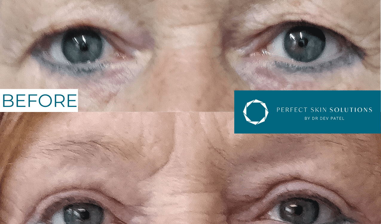 Before and after photo of eyes from blepharoplasty eyelid surgery woman