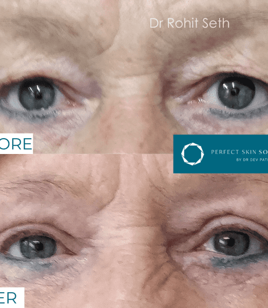 The Ultimate Guide to Treatment for Wrinkles Around the Eyes